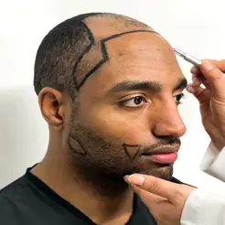 afro hair transplant 1